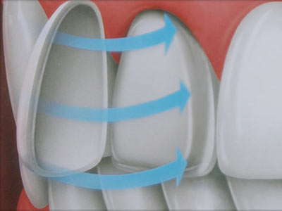 dental veneers
